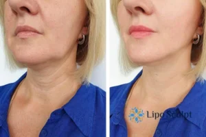 Double chin before and after Hi-Fu treatment 4 Book your double chin treatment Banstead today! We are here to help!