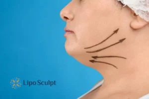 Double chin before and after Hi-Fu treatment 3 Boost your confidence with a Double chin treatment Banstead