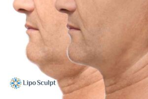 Double chin before and after Hi-Fu treatment 2 Double chin treatment Banstead from Lipo Sculpt - feel more confident today!