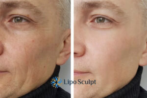 How to Fight Aging Symptoms 3 Fight Aging Symptoms Banstead With HIFU and Morpheus8 Today!