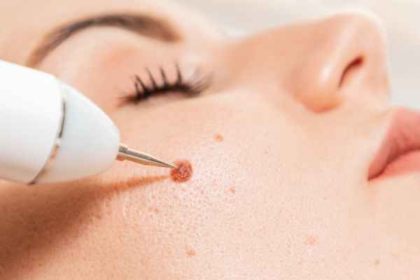CryoPen: 5 Skin Concerns It May Be Used to Treat 3 What actually happens during a CryoPen treatment Banstead?