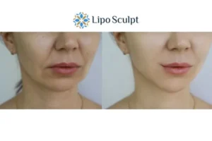 Explaining Total Skin Tightening Treatment And What It Can Do For You 2 Do you want to boost your self confidence? Give Morpheus8 Banstead a try today!