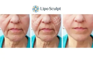 Explaining Total Skin Tightening Treatment And What It Can Do For You 3 Boost your confidence with Morpheus8 Banstead call our team today!