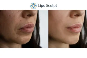 Explaining Total Skin Tightening Treatment And What It Can Do For You 4 Morpheus8 Banstead the best results - call our team today!