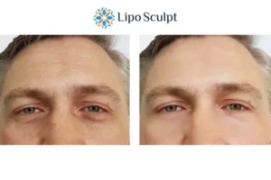 Explaining Total Skin Tightening Treatment And What It Can Do For You 6 Morpheus8 Banstead book in today to find out more!