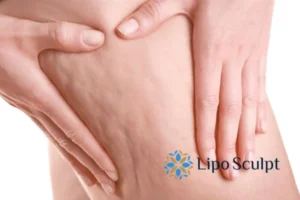 CoolSculpting for Legs: The Innovative Approach to Redefining Your Legs 5 Start your journey today book your coolsculpting treatment Banstead online today!